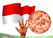 Sebelum Terkena, Ayo Kenali Apa Itu Monkeypox (Cacar Monyet), Simak..!!